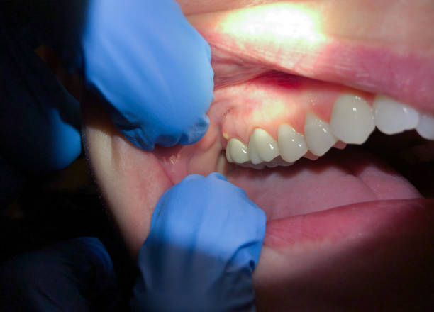Best Emergency Dental Extractions in Dunlap, OH