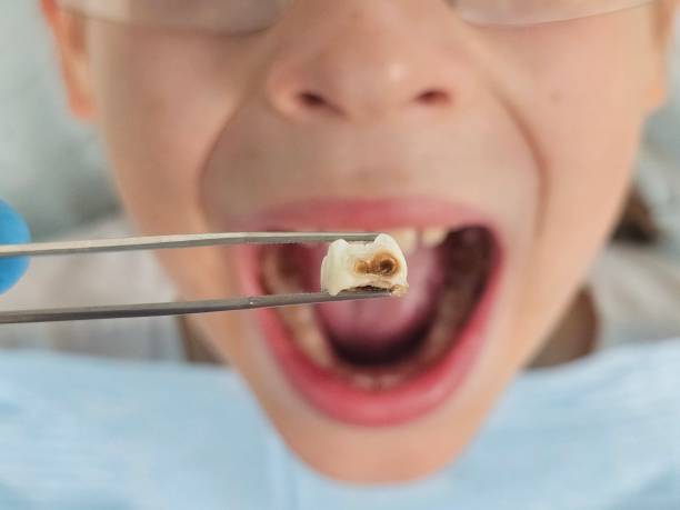 Best Emergency Dental Care for Abscessed Tooth in Dunlap, OH